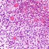 3A2 Langerhan's Cell Histiocytosis (Case 3) H&E 16