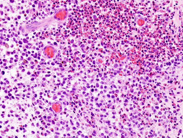 3A2 Langerhan's Cell Histiocytosis (Case 3) H&E 16