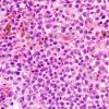 3A3 Langerhan's Cell Histiocytosis (Case 3) H&E 15