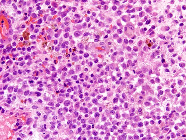 3A3 Langerhan's Cell Histiocytosis (Case 3) H&E 15