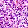 3A4 Langerhan's Cell Histiocytosis (Case 3) H&E 9