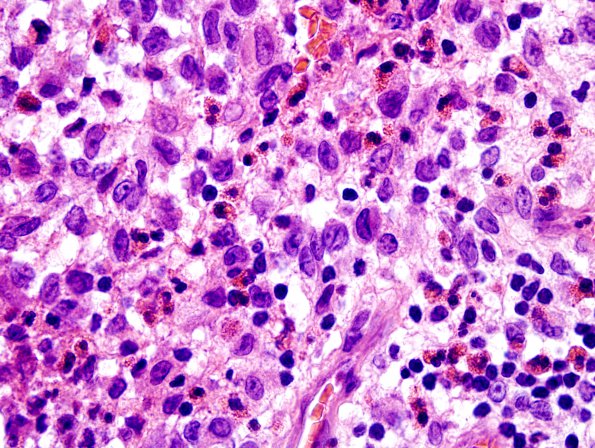 3A4 Langerhan's Cell Histiocytosis (Case 3) H&E 9