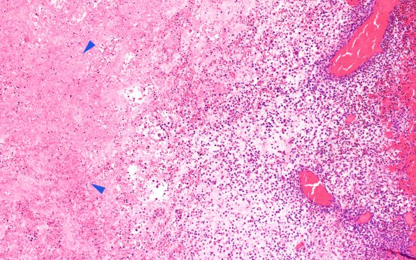 3A5 Langerhan's Cell Histiocytosis (Case 3) H&E 10X copy