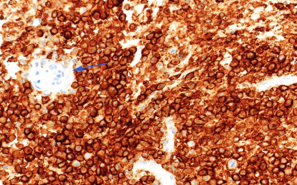 3B2 Langerhan's Cell Histiocytosis (Case 3) CD1a 40X copy