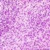 4B2 Langerhan's Cell Histiocytosis (Case 4) H&E 3.jpg