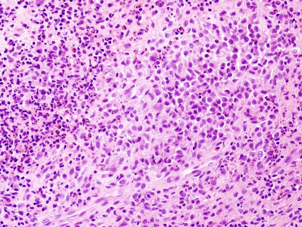 4B2 Langerhan's Cell Histiocytosis (Case 4) H&E 3.jpg