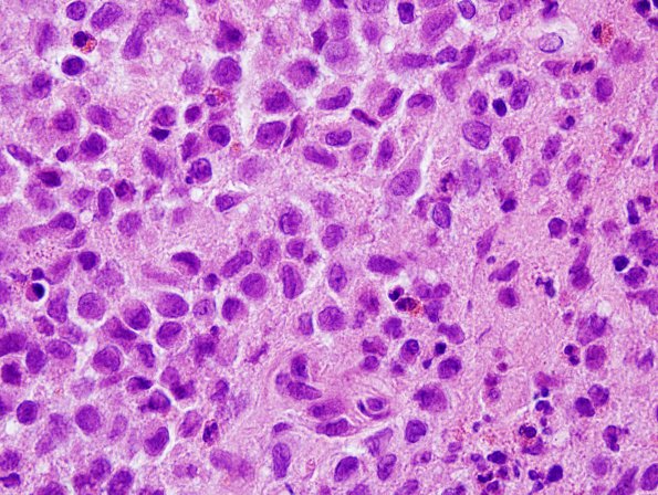 4B3 Langerhan's Cell Histiocytosis (Case 4) H&E 6.jpg