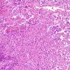 4B4 Langerhans Cell Histiocytosis (Case 4) H&E 4.jpg