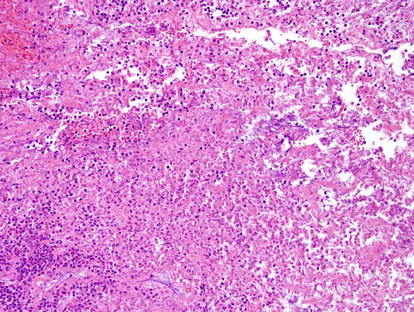 4B4 Langerhans Cell Histiocytosis (Case 4) H&E 4.jpg