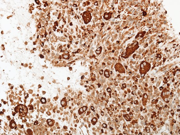 4C2 Langerhan's Cell Histiocytosis (Case 4) CD68 3.jpg