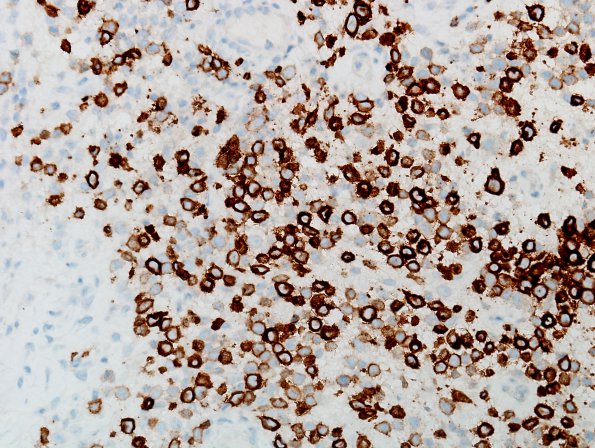 4D2 Langerhan's Cell Histiocytosis (Case 4) CD1a 3.jpg