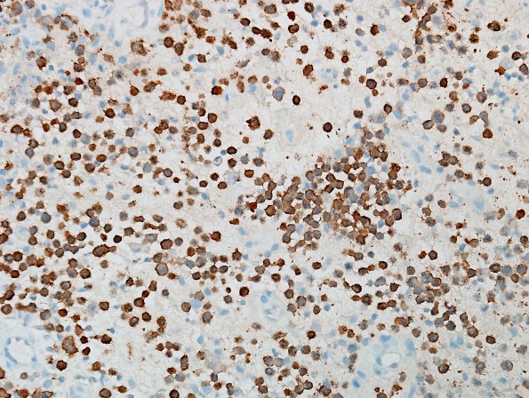 4E2 Langerhan's Cell Histiocytosis (Case 4) S100 1.jpg