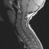 5A1 Langerhans Cell Histiocytosis (Case 5) T1 - Copy