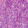 5B1 Langerhans Cell Histiocytosis (LCH, Case 5) H&E 2.jpg