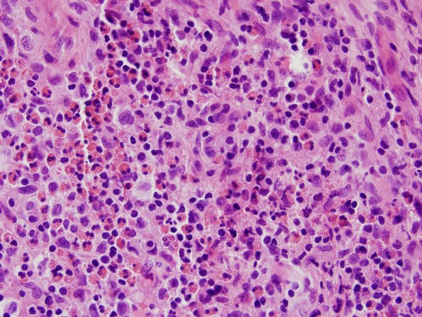 5B1 Langerhans Cell Histiocytosis (LCH, Case 5) H&E 2.jpg