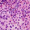 5B2 Langerhan's Cell Histiocytosis (LCH, Case 5) H&E 100X 1.jpg