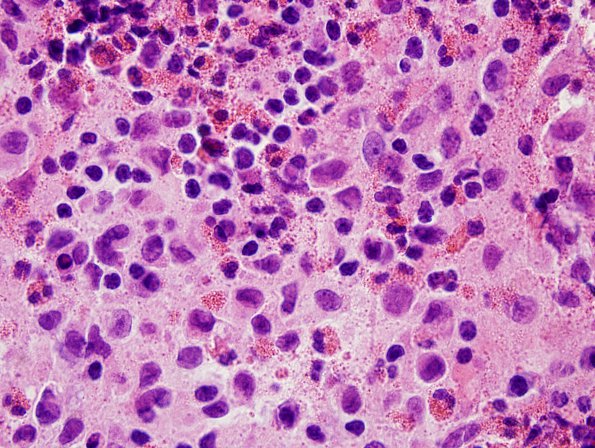 5B2 Langerhan's Cell Histiocytosis (LCH, Case 5) H&E 100X 1.jpg