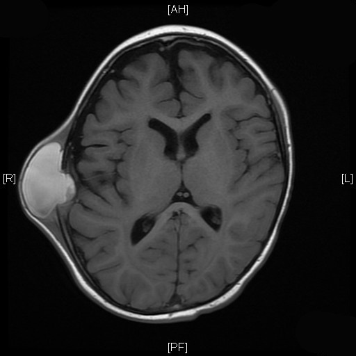 6A Langerhans Cell Histiocytosis (Case 6) 1 - Copy