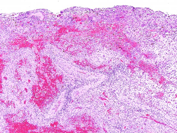 6C1 Langerhans Cell Histiocytosis (Case 6) H&E 1.jpg