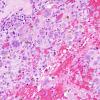 6C2 Langerhans Cell Histiocytosis (Case 6) H&E 2.jpg