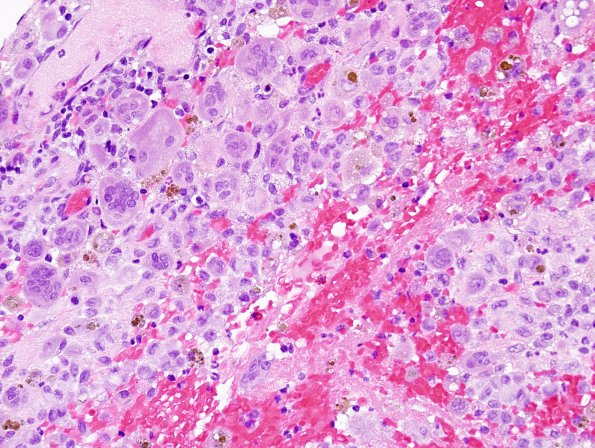 6C2 Langerhans Cell Histiocytosis (Case 6) H&E 2.jpg