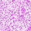 6C3 Langerhans Cell Histiocytosis (Case 6) H&E 5.jpg