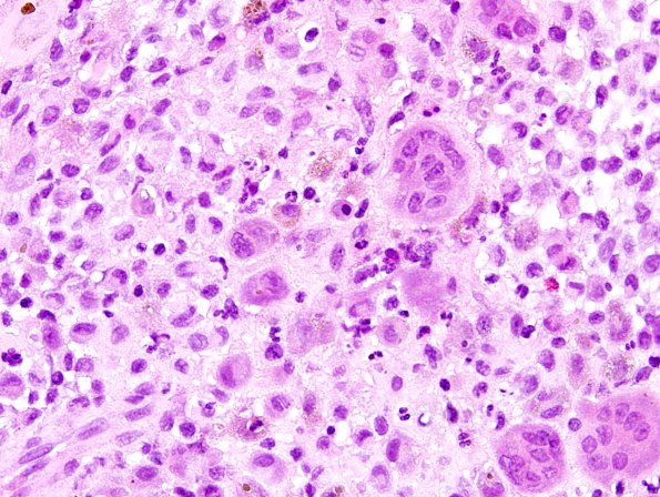 6C3 Langerhans Cell Histiocytosis (Case 6) H&E 5.jpg