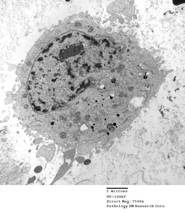 7A3 LCH (Case 7) Birbeck granules EM 009 - Copy