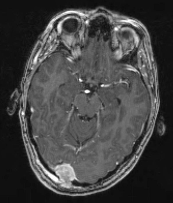 8A LCH (eosinophilic granuloma, Case 8) T1 2 - Copy