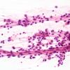 8B1 LCH (eosinophilic granuloma, Case 8) H&E 1