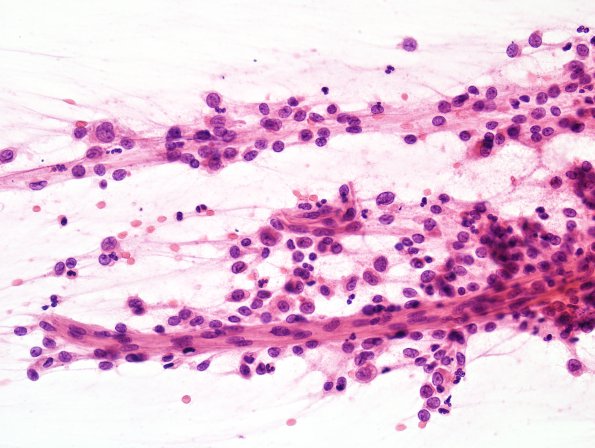 8B1 LCH (eosinophilic granuloma, Case 8) H&E 1