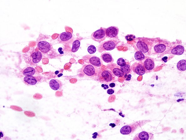 8B2 LCH (eosinophilic granuloma, Case 8) Smear 100x 2