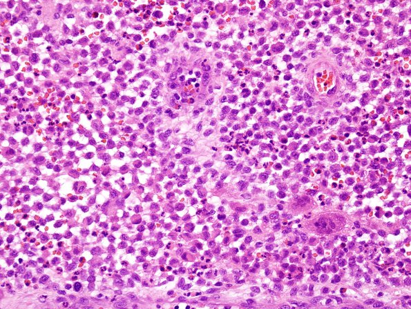 8B3 LCH (eosinophilic granuloma, Case 8) H&E 4