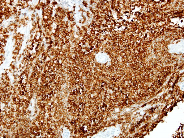 8C LCH (eosinophilic granuloma, Case 8) CD1a 1