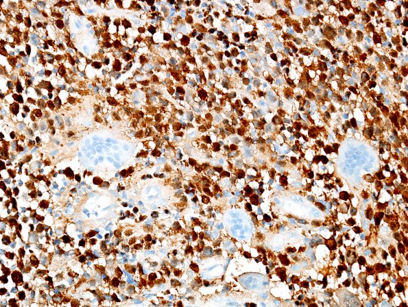 8D LCH (eosinophilic granuloma, Case 8) S100 1