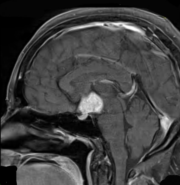 9A1 LCH (Gaegel's Granuloma) (Case 9) T1 W 2 - Copy