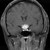 9A2 LCH (Gaegel's Granuloma) (Case 9) T1 W 1 - Copy