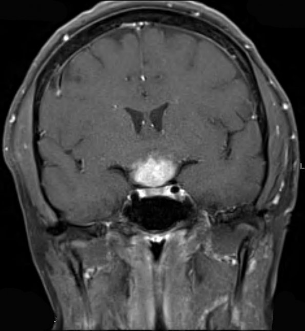 9A2 LCH (Gaegel's Granuloma) (Case 9) T1 W 1 - Copy