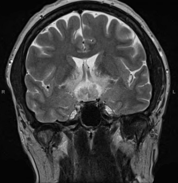 9A3 LCH (Gaegel's Granuloma) (Case 9) T2 3 - Copy