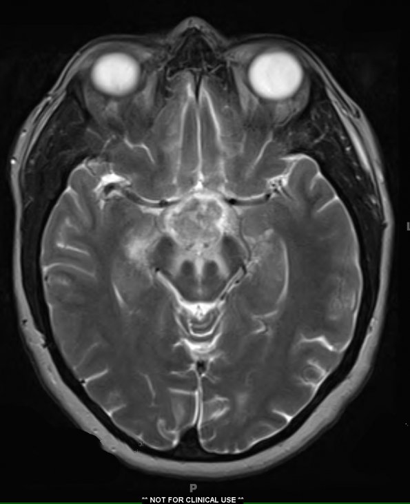 9A4 LCH (Gaegel's Granuloma) (Case 9) T2 1 - Copy