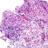 9B1 LCH (Gaegel's Granuloma) (Case 9) H&E 2