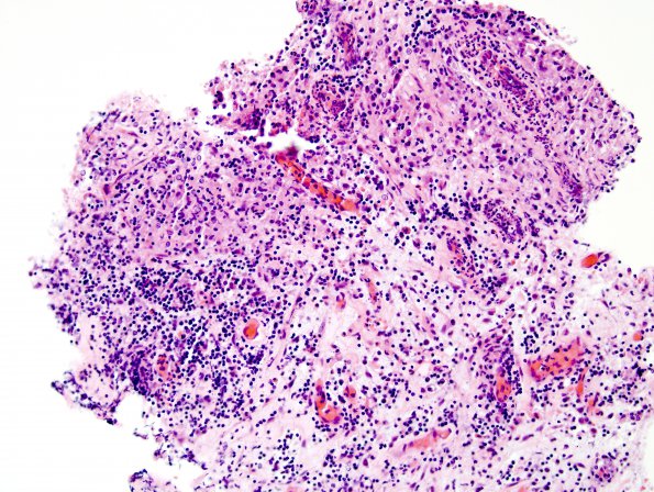 9B1 LCH (Gaegel's Granuloma) (Case 9) H&E 2