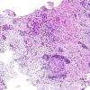 9B2 LCH (Gaegel's Granuloma) (Case 9) H&E 1