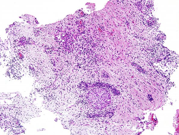 9B2 LCH (Gaegel's Granuloma) (Case 9) H&E 1