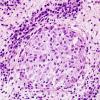 9B3 LCH (Gaegel's Granuloma) (Case 9) H&E 3