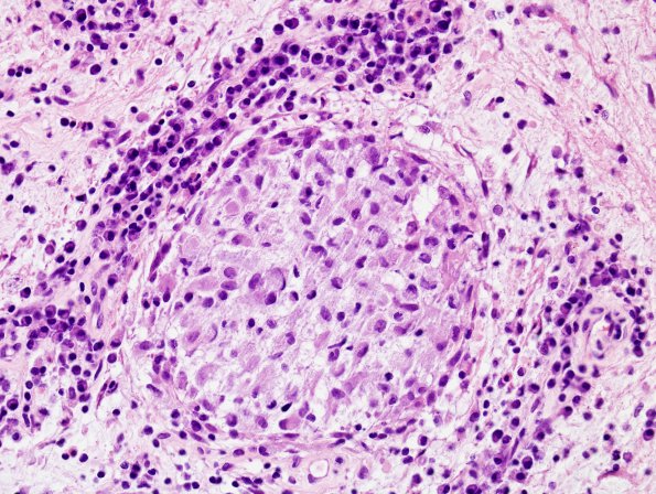 9B3 LCH (Gaegel's Granuloma) (Case 9) H&E 3