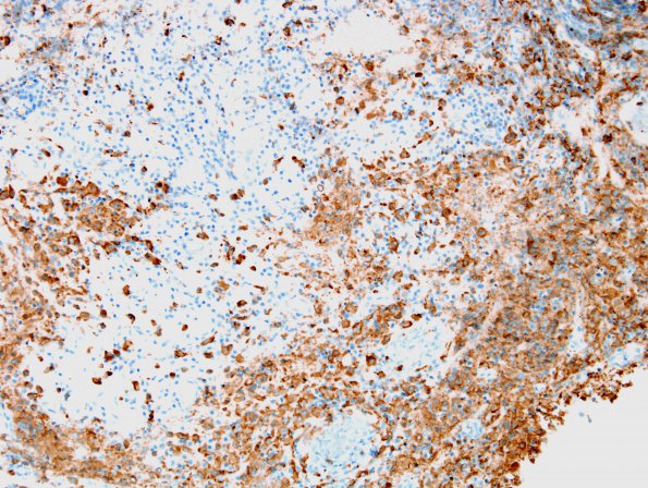 9C LCH (Gaegel's Granuloma) (Case 9) CD163 2