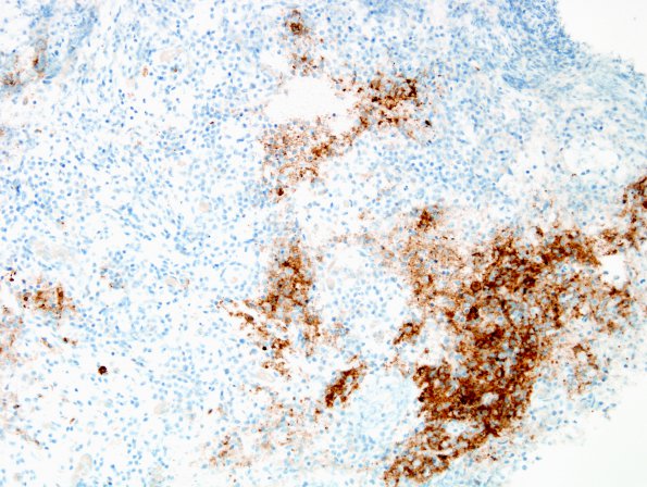 9D LCH (Gaegel's Granuloma) (Case 9) CD1a 1