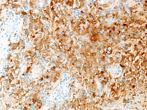 9E LCH (Gaegel's Granuloma) (Case 9) S100 1