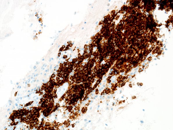 9F2 LCH (Gaegel's Granuloma) (Case 9) CD20